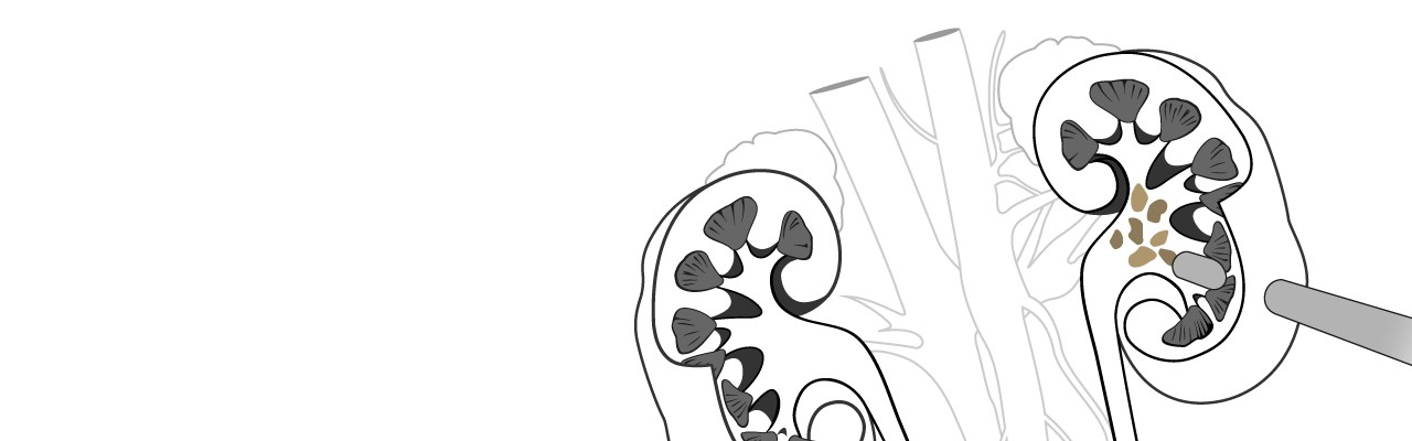 Stones_In_The_Urinary_Tract