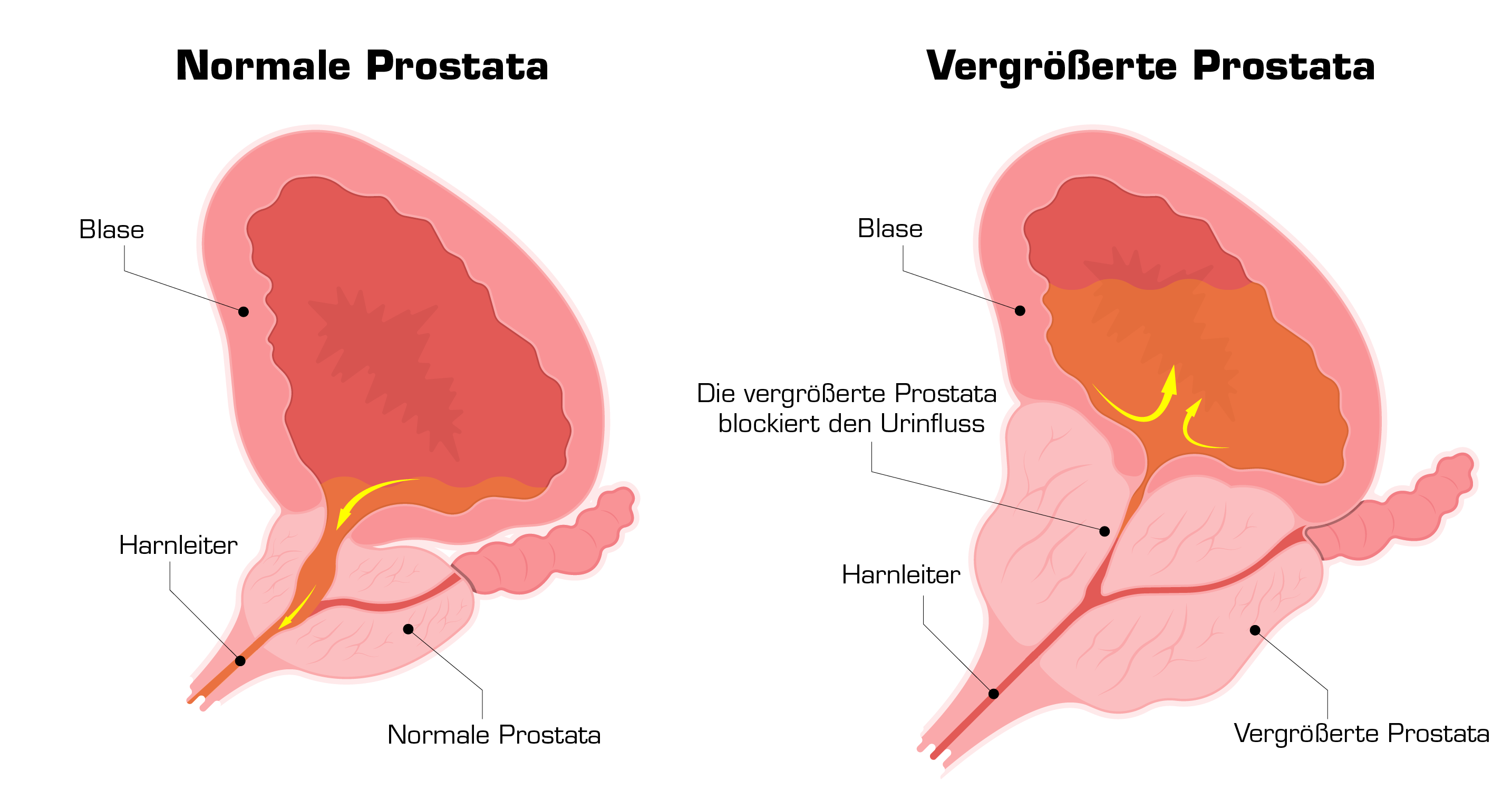 normal vs enlarged prostate