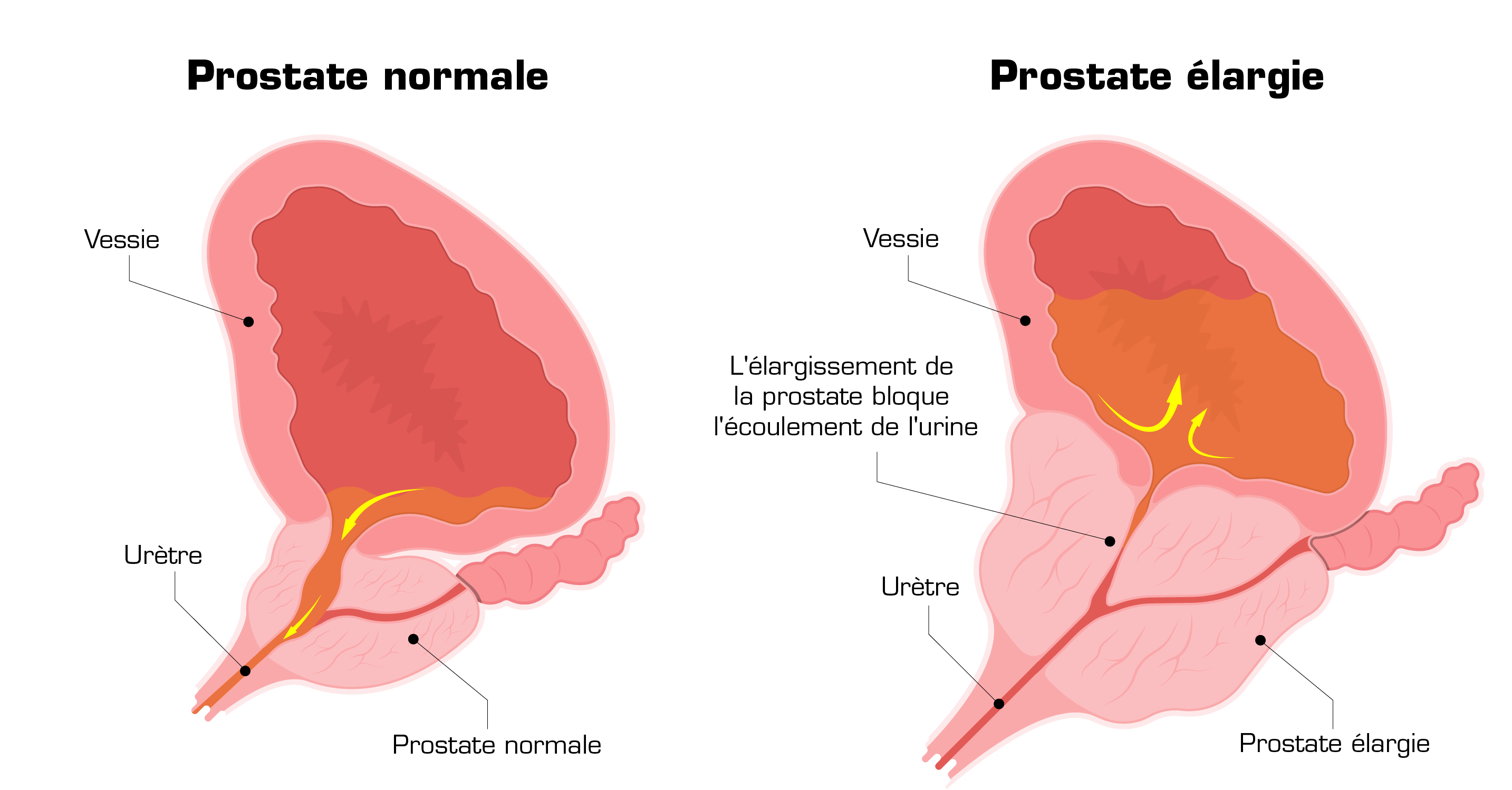 normal vs enlarged prostate