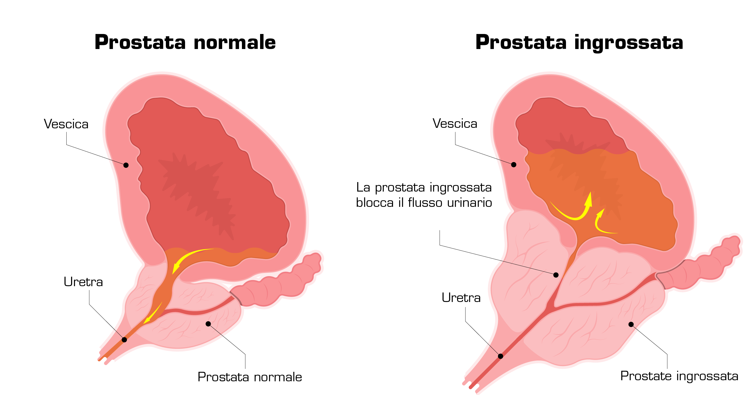 normal vs enlarged prostate