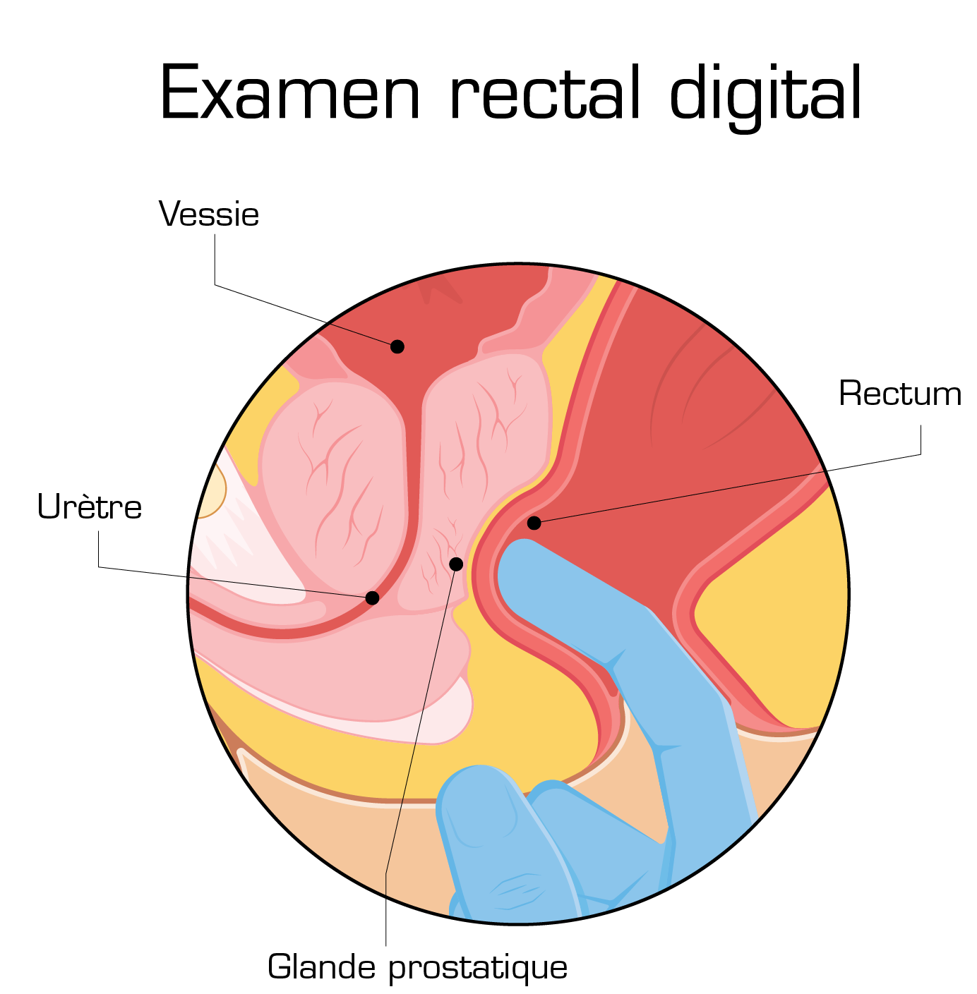 digital rectal exam