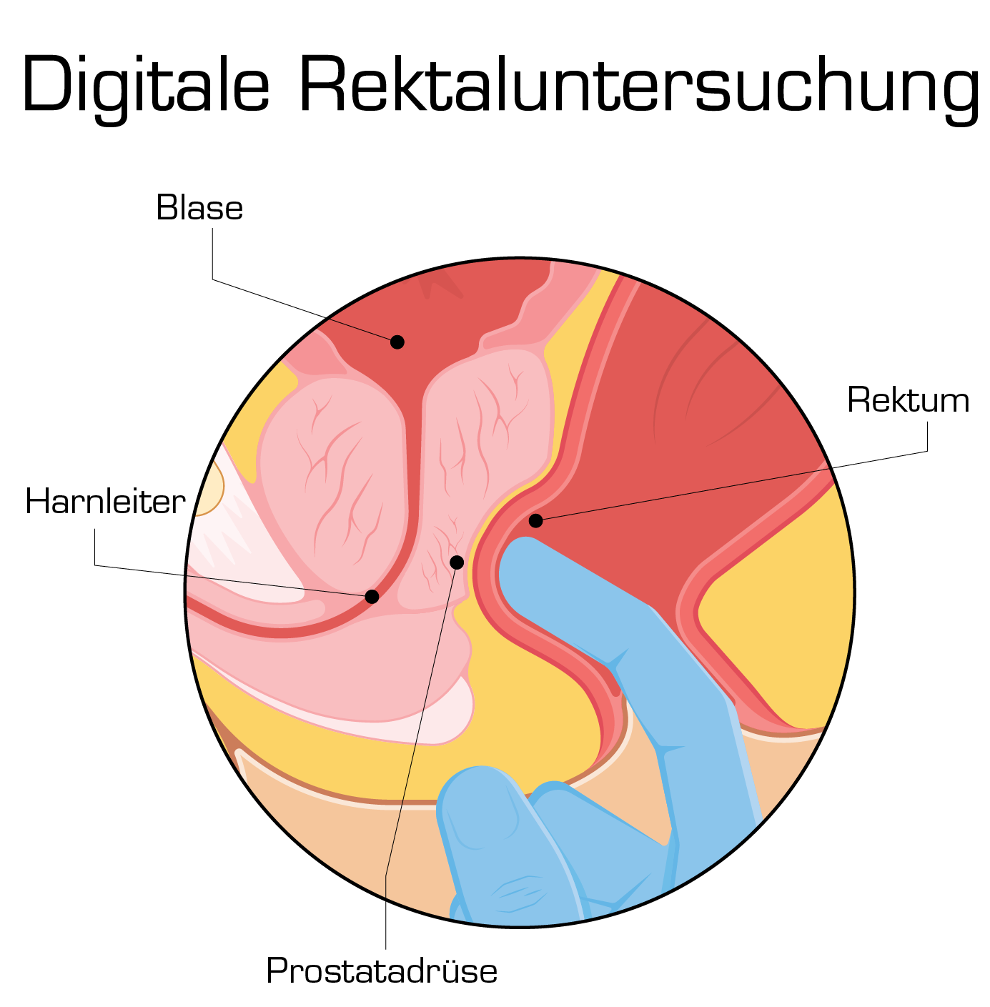 digital rectal exam