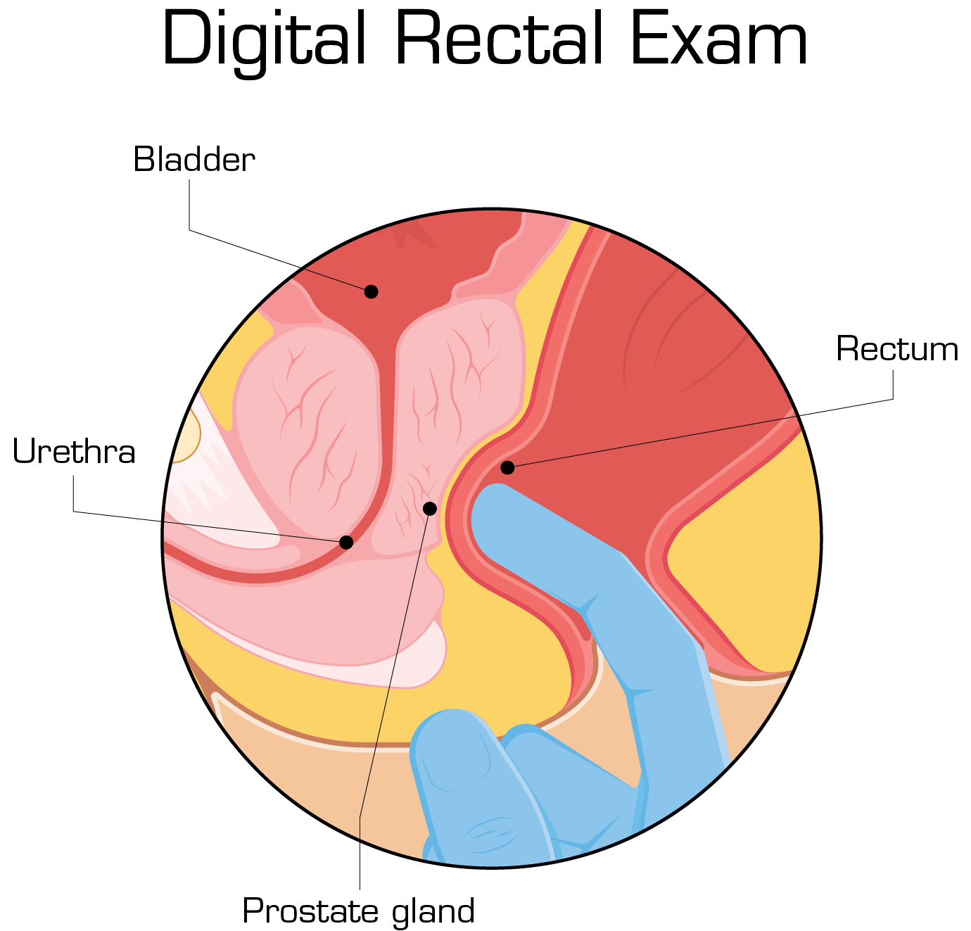 digital rectal exam