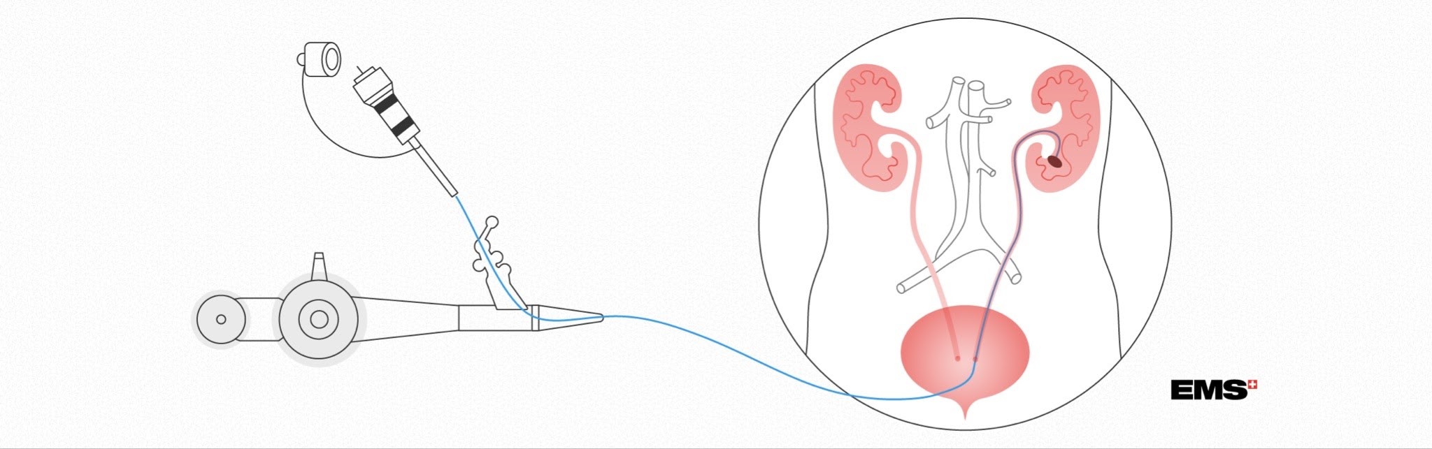 flexible ureteroscopy