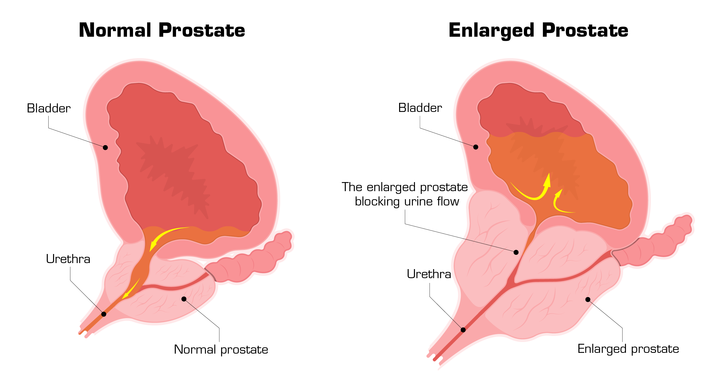 benign prostate hyperplasia ncbi