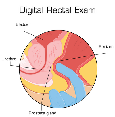 digital rectal exam