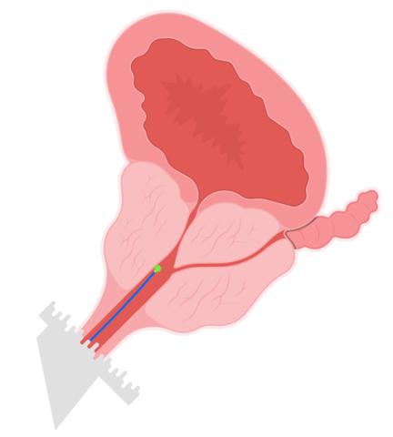 bph illustration